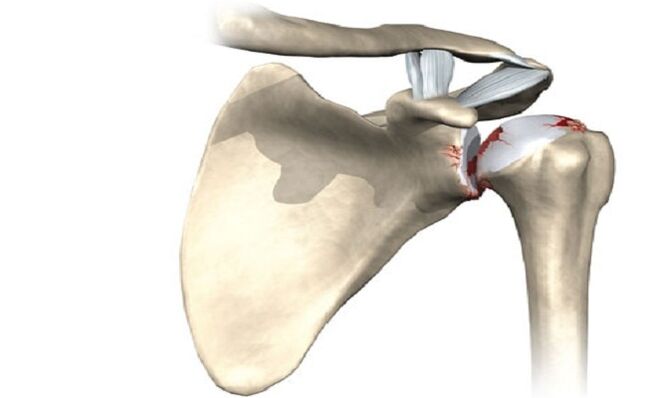liječenje medicinske artroze ramenog zgloba deformirajuća artroza liječenja koljena 1 stupanj