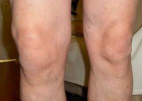 liječenje akutne artroze koljena