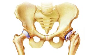 bol u koljenu u zglobovima artritična zgloba četke liječenje
