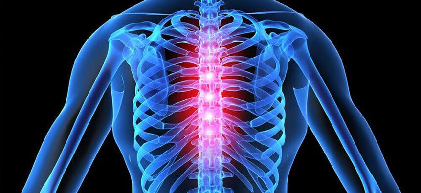 Pogoršanje osteohondroze torakalne kralježnice