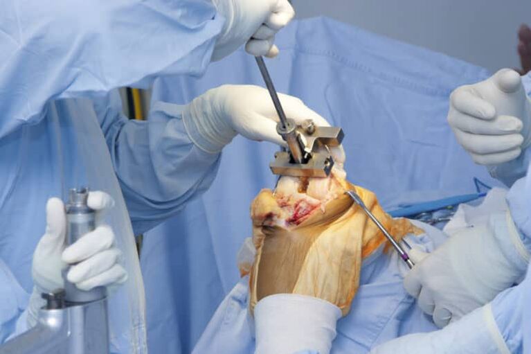 operacija artroze koljena