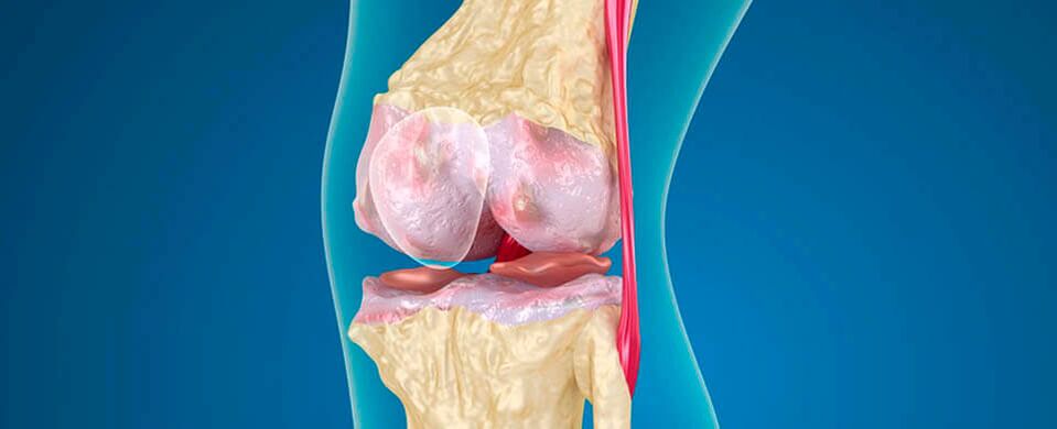 artroza koljena kao uzrok boli