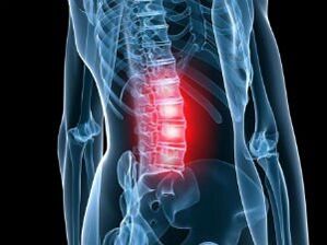 Osteohondroza lumbalne kralježnice