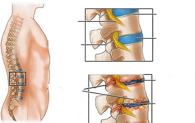 Osteohondroza lumbalne regije