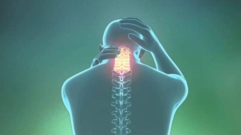 Osteohondroza cervikalne regije