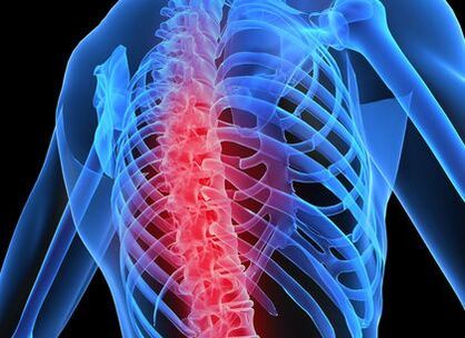 osteohondroza torakalne kralježnice