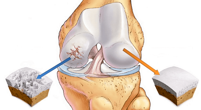 zdrava hrskavica i hrskavica zahvaćena artrozom